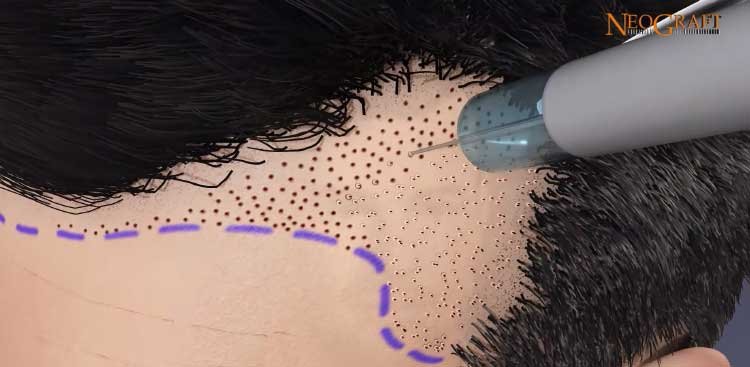 advanced automatic hair transplantation