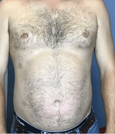 1 psoriasis after