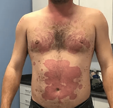 1 psoriasis before