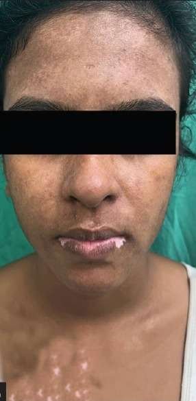 1 vitiligo after
