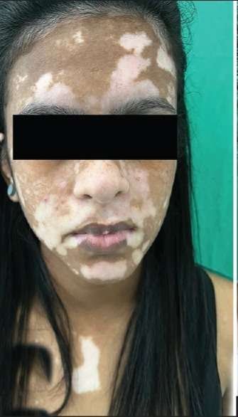 1vitiligo before