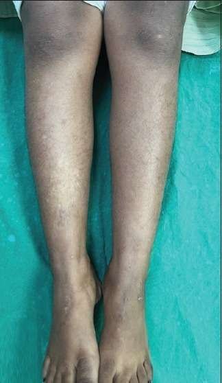2 vitiligo after