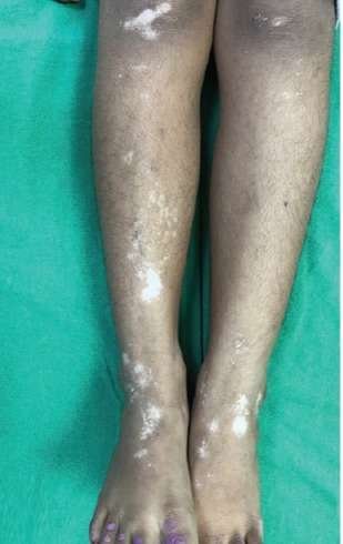 2 vitiligo before