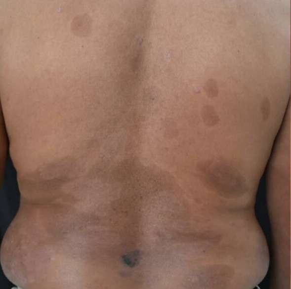 2psoriasis after