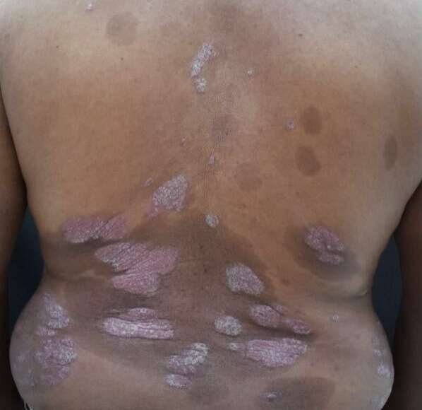 2psoriasis before