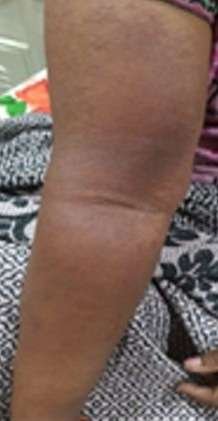 3psoriasis after