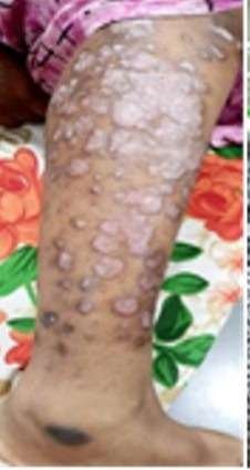 3psoriasis before