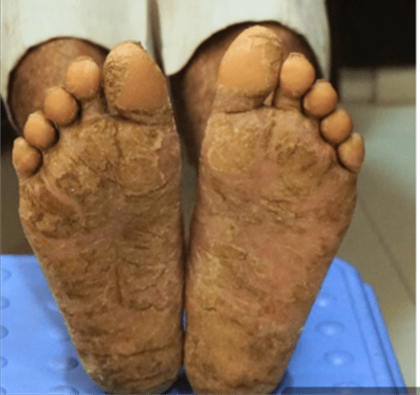 foot eczema beofore