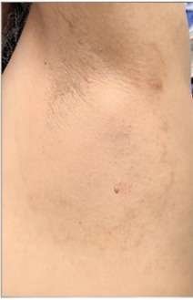 fungal infections after