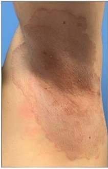 fungal infections before