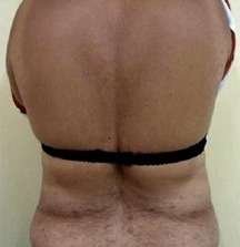 lichen planus after