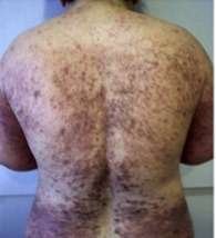 lichen planus before