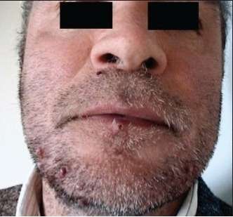 rosecea after