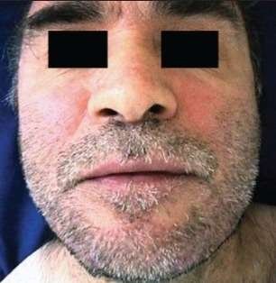 rosecea before