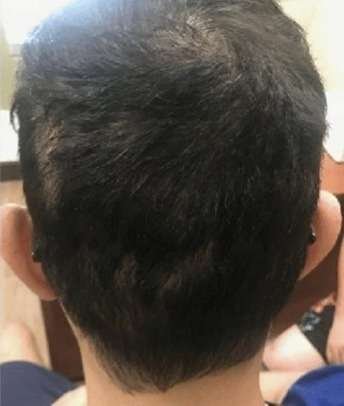 alopecia areata after