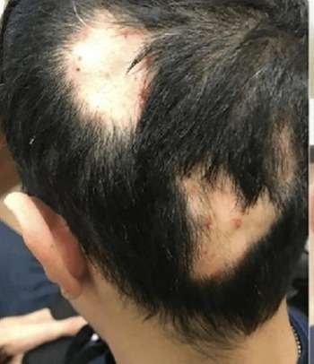 alopecia areata before