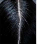 antidandruff treatment after