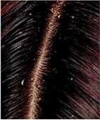 antidandruff treatment before