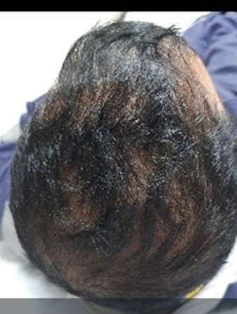 exosomes hair after
