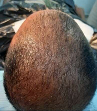 exosomes hair before