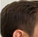 greying of hair after