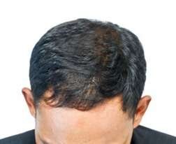 hair exosomes after