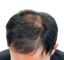 hair exosomes before