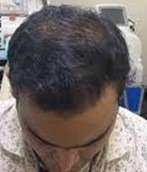 hair grafting after2