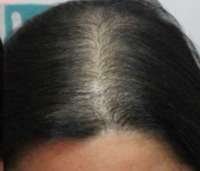 hair prp after
