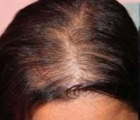 hair prp before