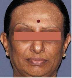 lichen planus face pigmentation after
