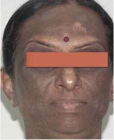 lichen planus face pigmentation before
