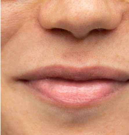 lip hyperpigmentation after