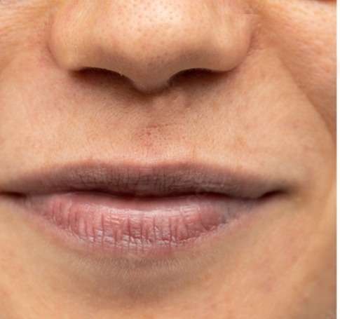 lip hyperpigmentation before