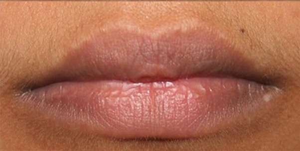 lip pigmentation after