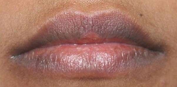 lip pigmentation before