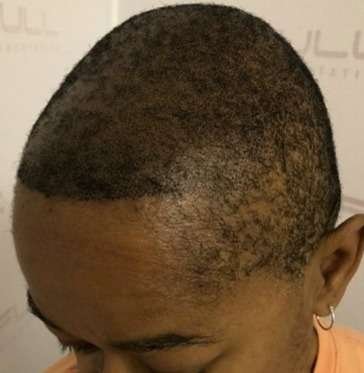 scalp micropigmentation after