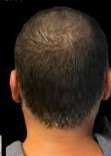 scalp micropigmentation smp after