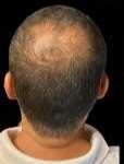 scalp micropigmentation smp before