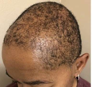 scalp miropigmentation before