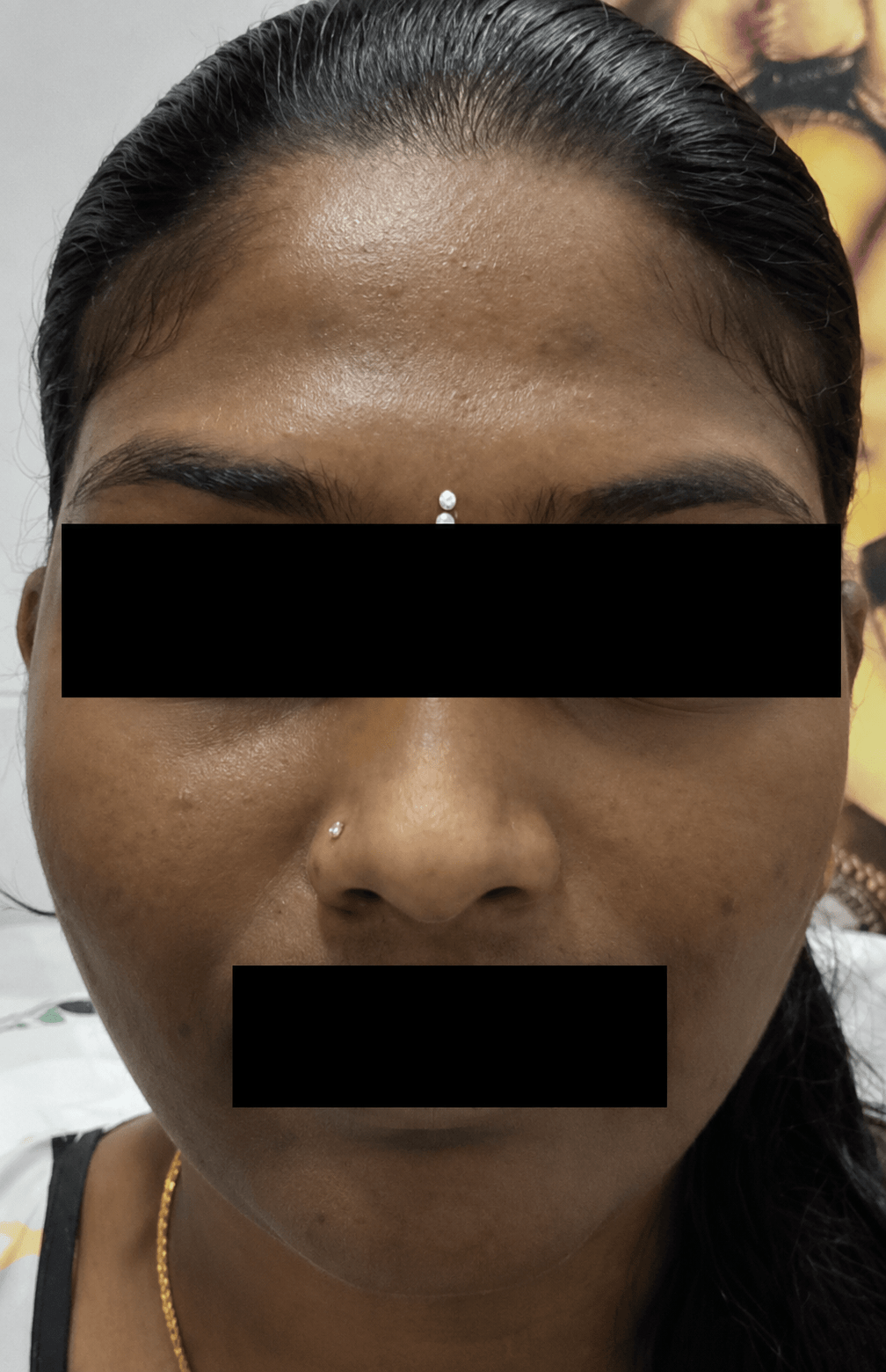 before (15)