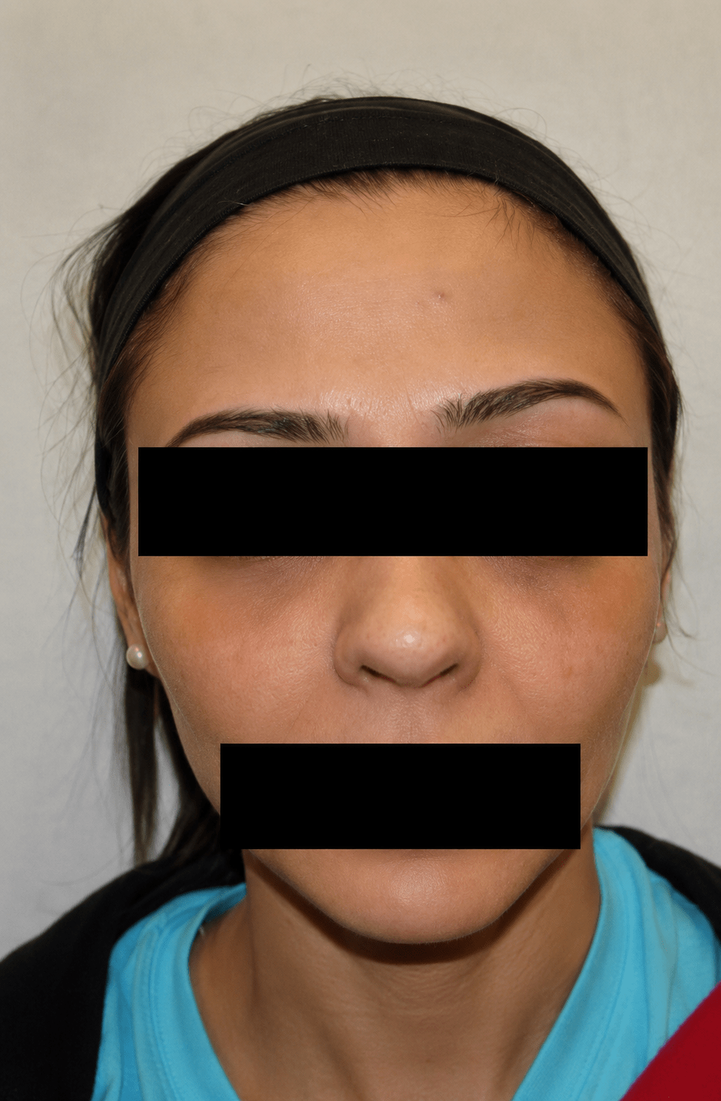before (17)