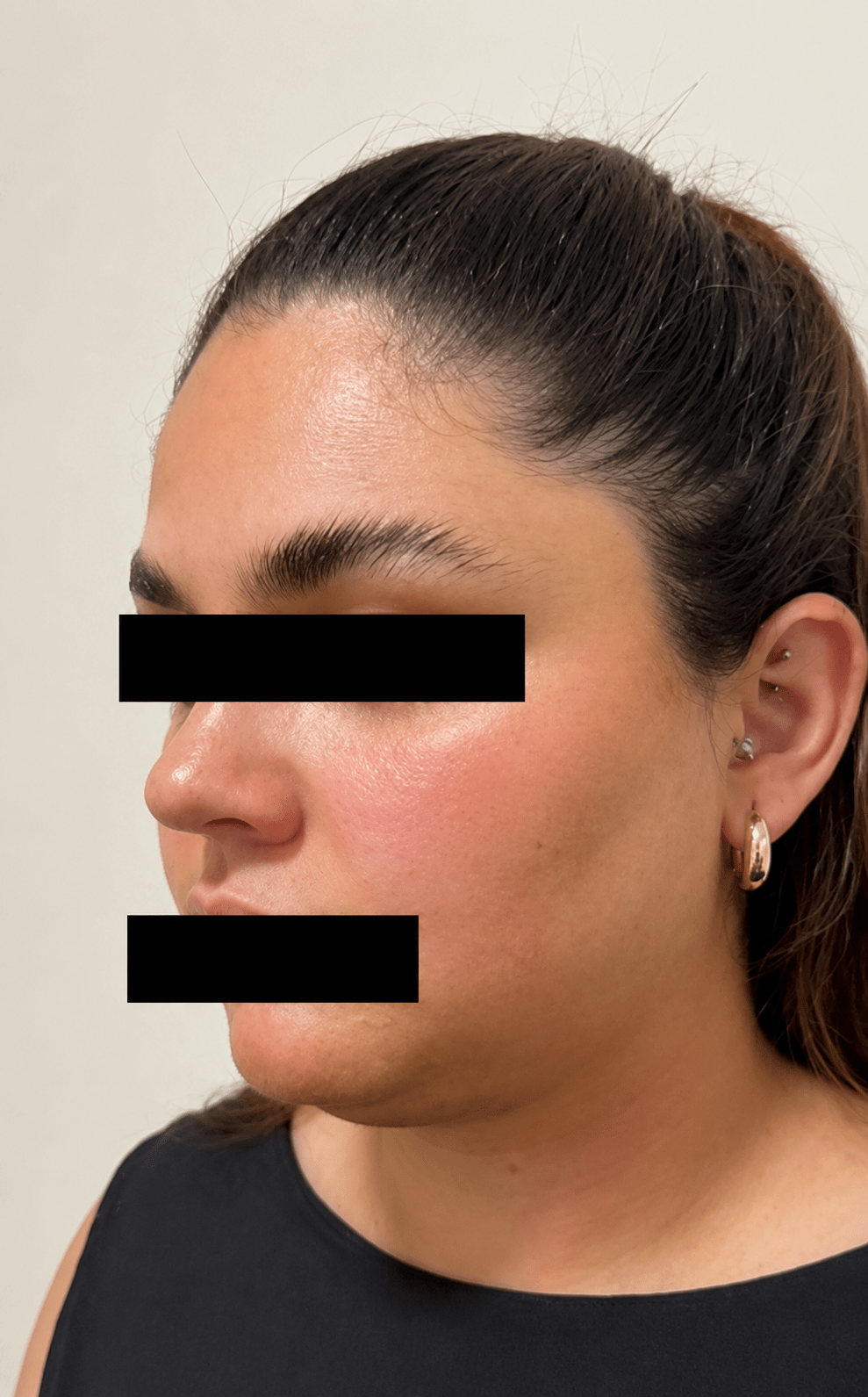 before (20)