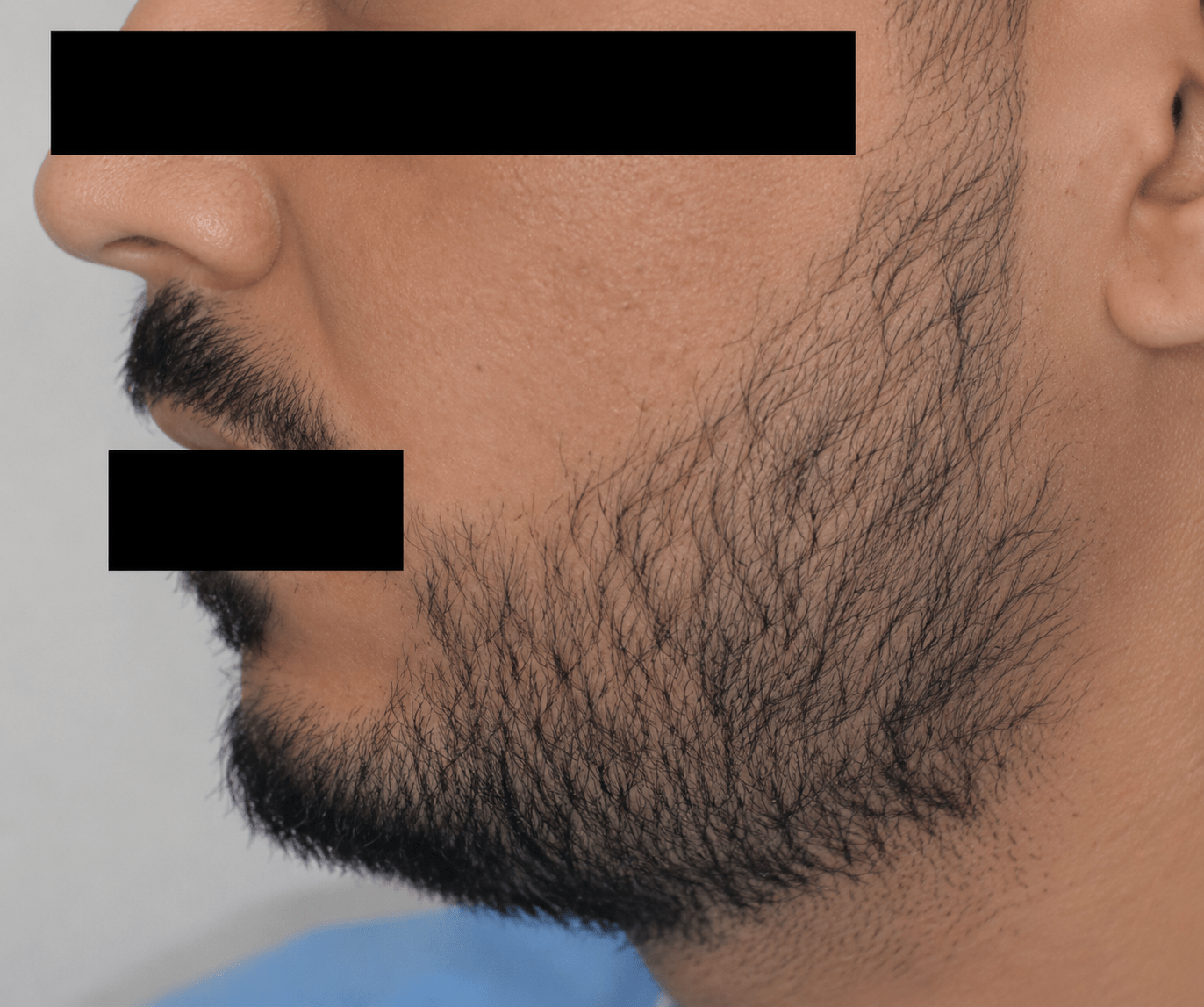 before (24)