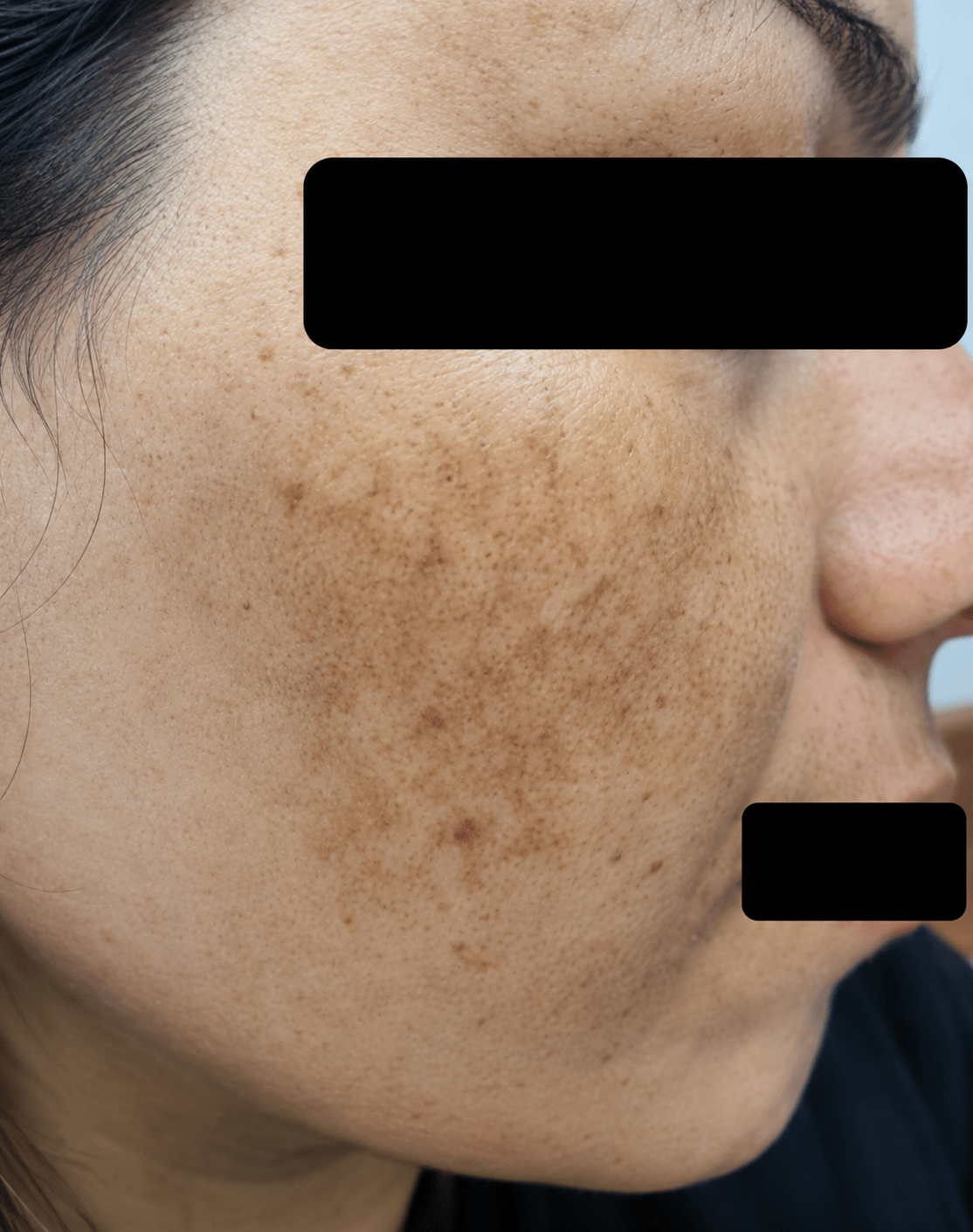 before (30)