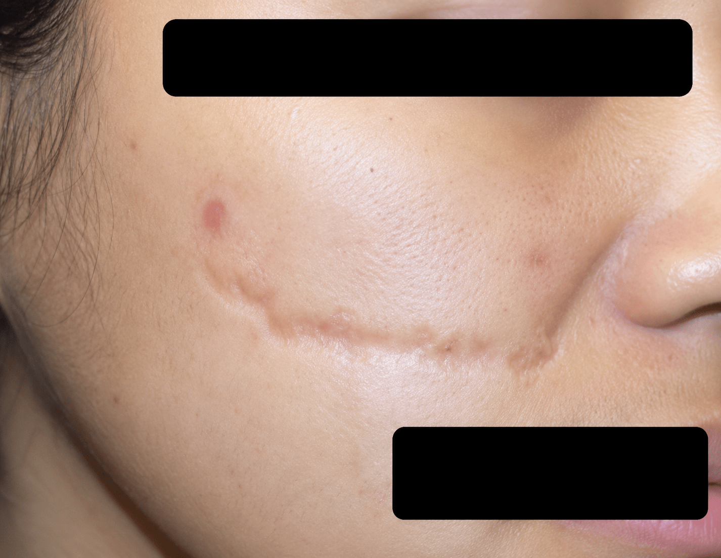 before (35)