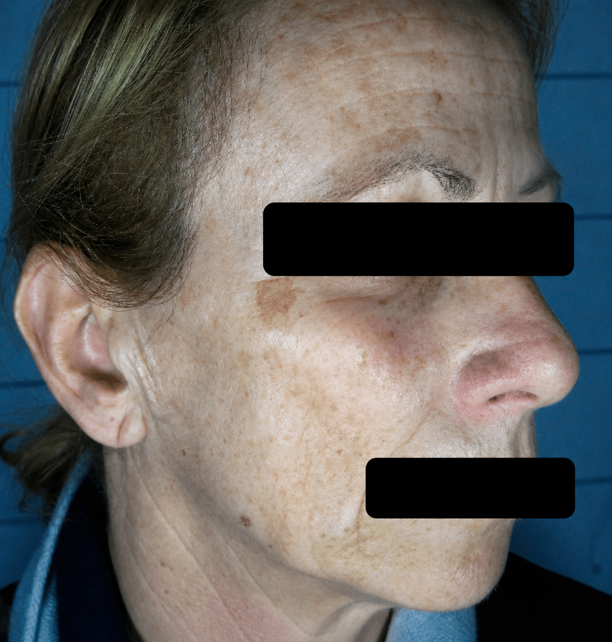 before (37)