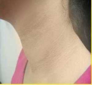 acanthosis nigricans after