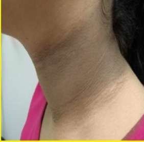 acanthosis nigricans before
