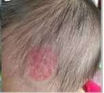 birth mark after